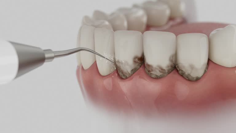 Trusted Wisdom Tooth Removal service in Graysville, AL - Dentist Open Now